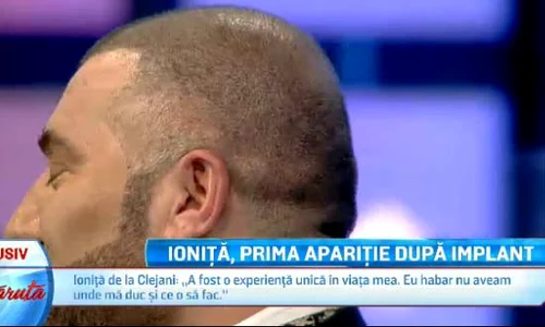 Ioniță se declară foarte mulțumit de implantul de păr jpeg