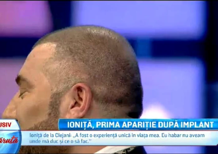 Ioniță se declară foarte mulțumit de implantul de păr