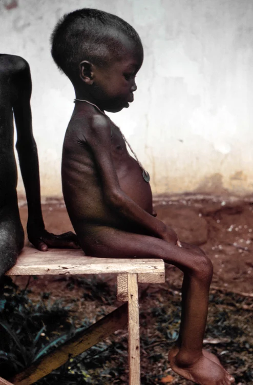 Copil din Biafria 1968 care suferă de malnutriție