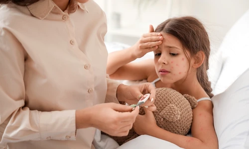 Tot ce trebuie sa stii despre scarlatina, varicela si rujeola de la primele simptome  Sursa foto shutterstock 2121636500 jpg
