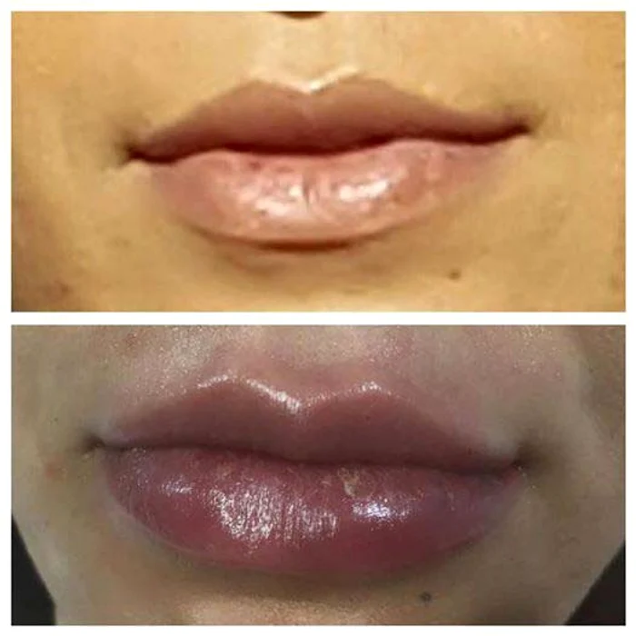 Aşa arată buzele Andrei după intervenţie 