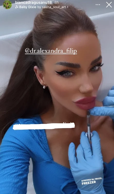 Bianca Drăgușanu și-a mărit buzele