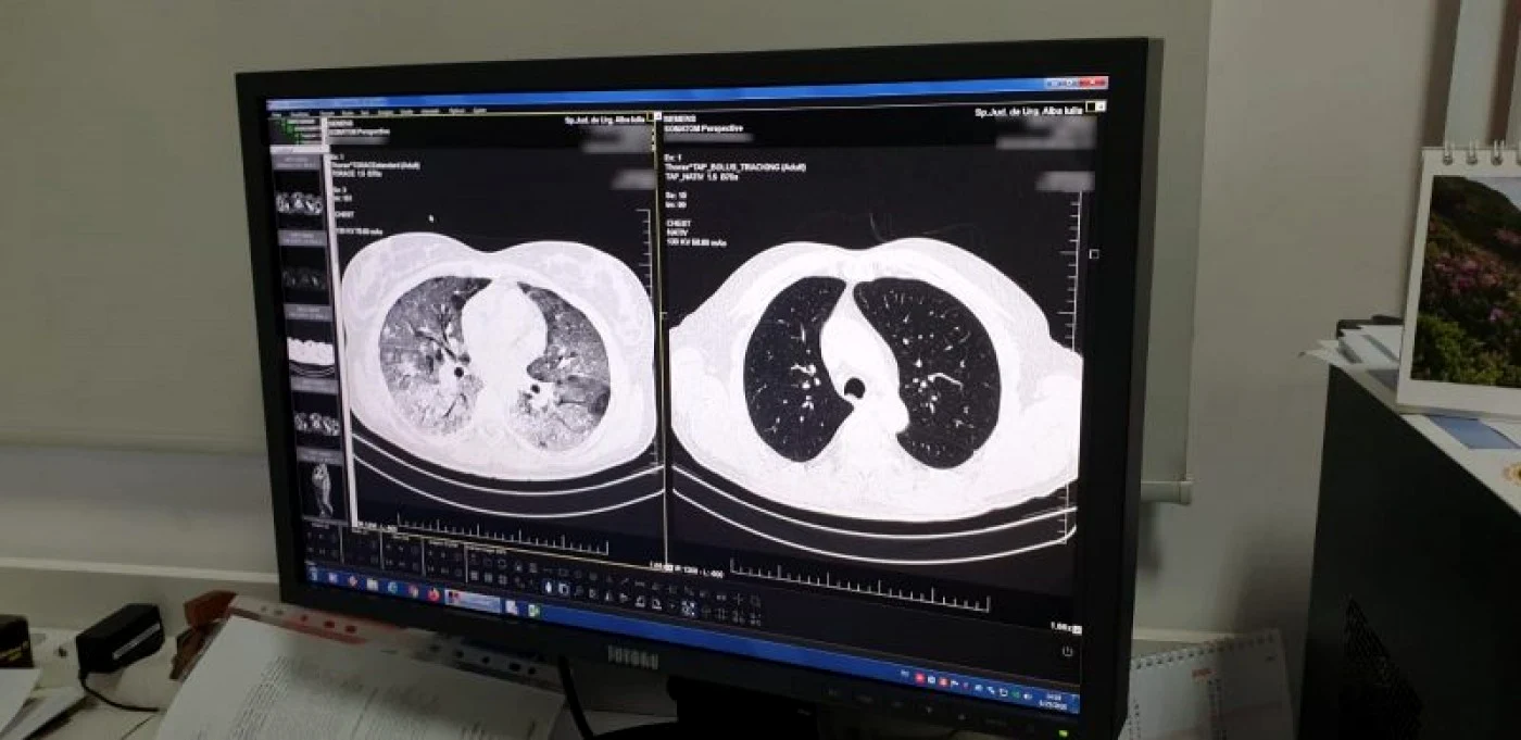 Leziunile pulmonare pe care infecţia cu SARS-CoV-2 le produce sunt, unele, ireversibile FOTO: arhiva