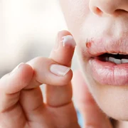 Herpes bucal sau labial Foto Actu fr jpeg
