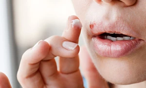 Herpes bucal sau labial Foto Actu fr jpeg