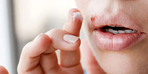 Herpes bucal sau labial Foto Actu fr jpeg