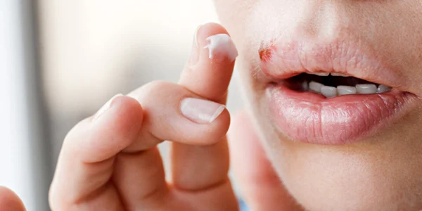 Herpes bucal sau labial Foto Actu fr jpeg