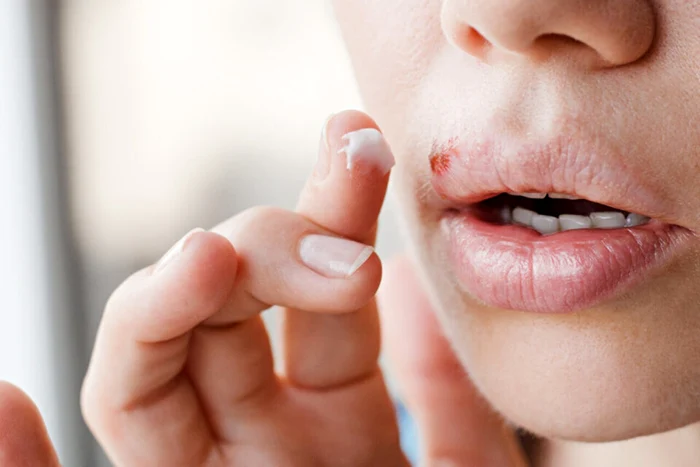 Imaginea unui herpes bucal la o femeie care-și aplică o cremă ca tratament Foto Actu.fr