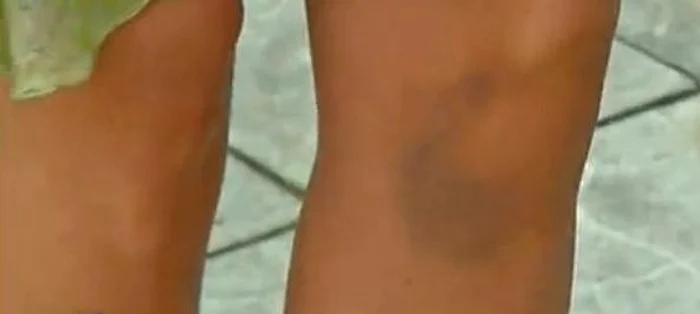 Cristina Spătar a rămas cu urme serioase după accidentul din 15 iunie