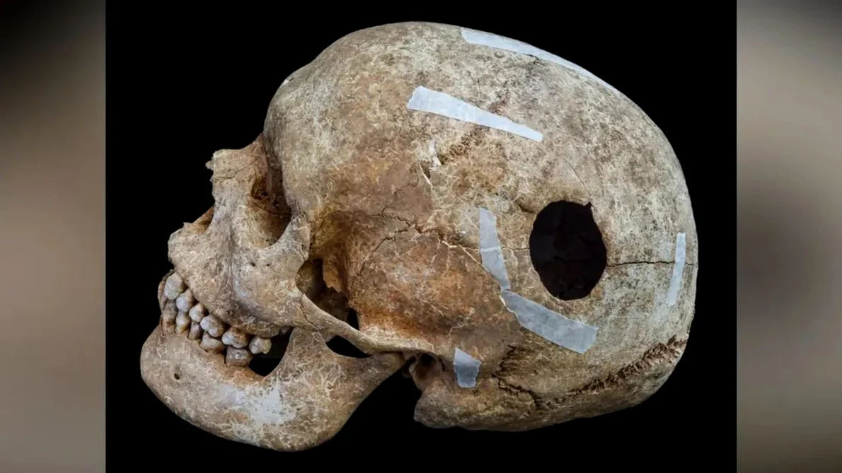 Gaura ovală avea o dimensiune de 3 cm, iar testele inițiale cu radiocarbon sugerează că bărbatul a trăit între anii 772 și 891 d.Hr. (© Cambridge Archaeological Unit / David Matzliach)