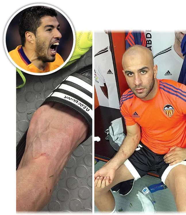 
    Tunisianul le-a arătat prietenilor urmele loviturii lui Suarez  