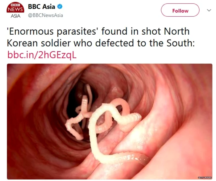 Tenie de 27 de centimetri gasita in intestitenele unui soldat nord-coreean