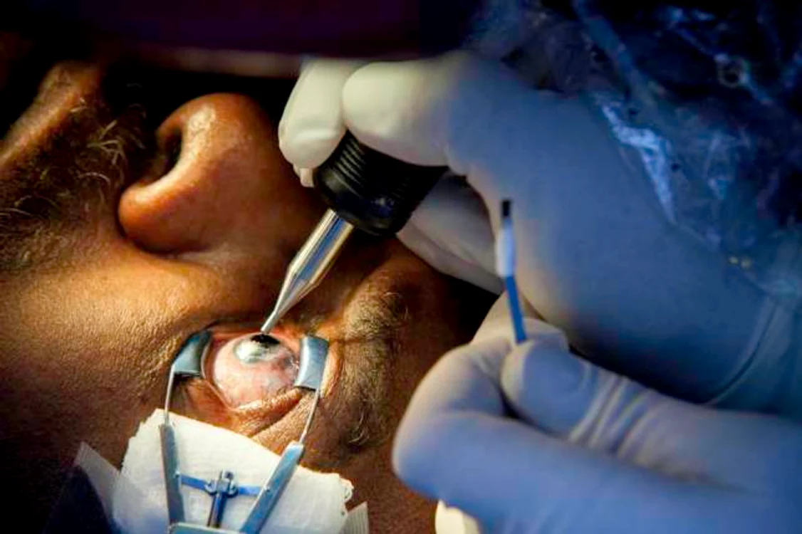 Procedura, care durează o oră, rezolvă doar partea estetică: pacientul are încă probleme cu ochiul respectiv