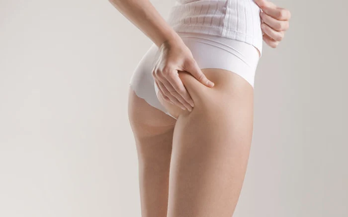 1 de ce apare celulita jpg jpeg