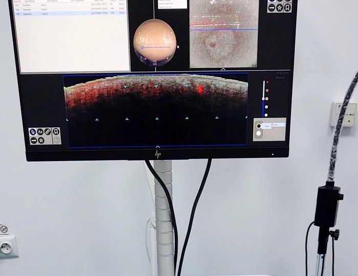 Aparat unic pentru depistarea cancerului de piele FOTO: Spitalul de Boli Infecțioase