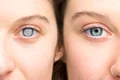 cataracta jpg