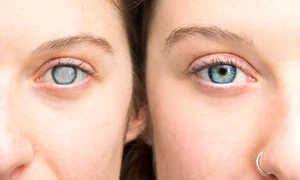 cataracta jpg