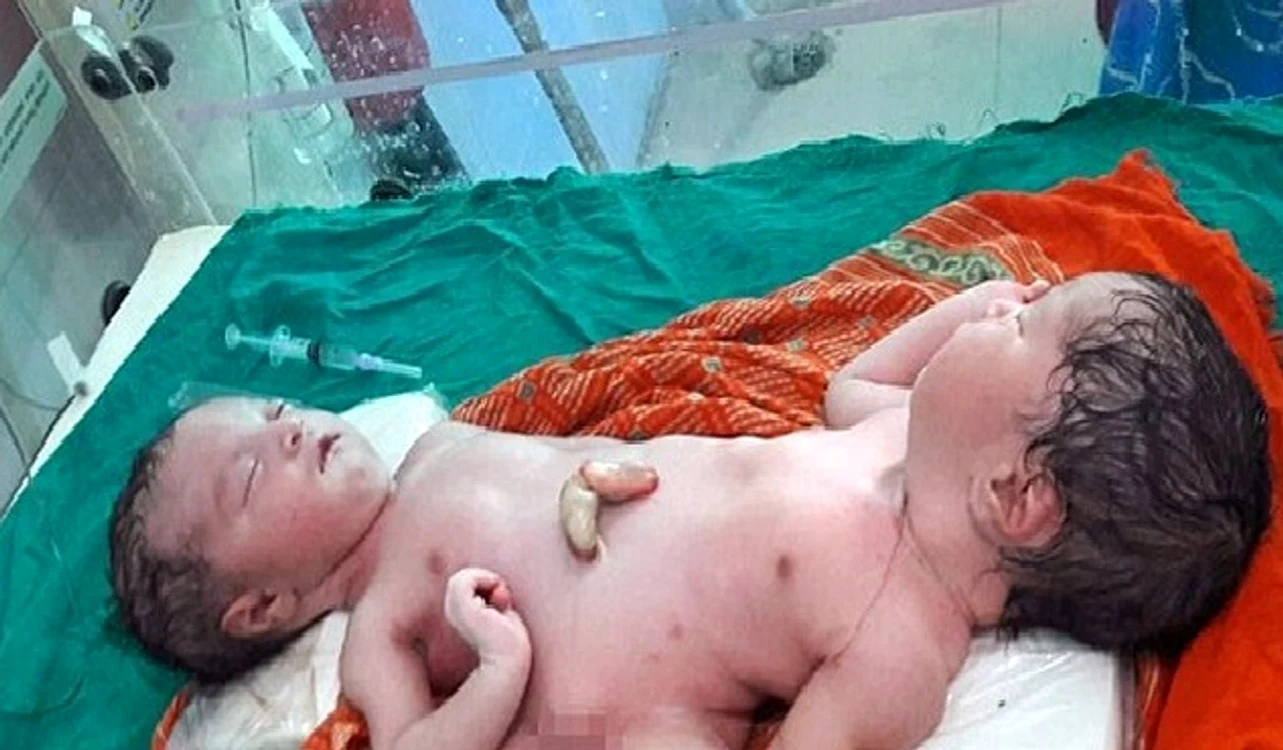 
    Doi gemeni siamezi au organe vitale comune și o singură pereche de picioareFoto Daily Mail  