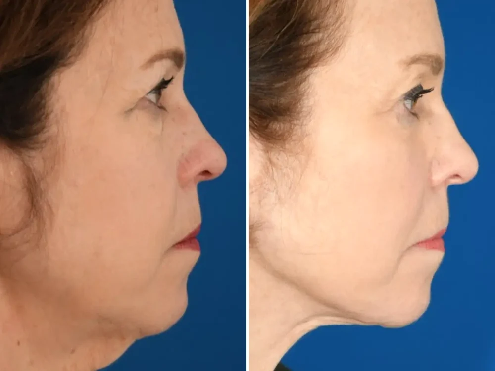 Suma uriașă cheltuită de o femeie de 65 de ani pe proceduri cosmetice / foto: Business Insider