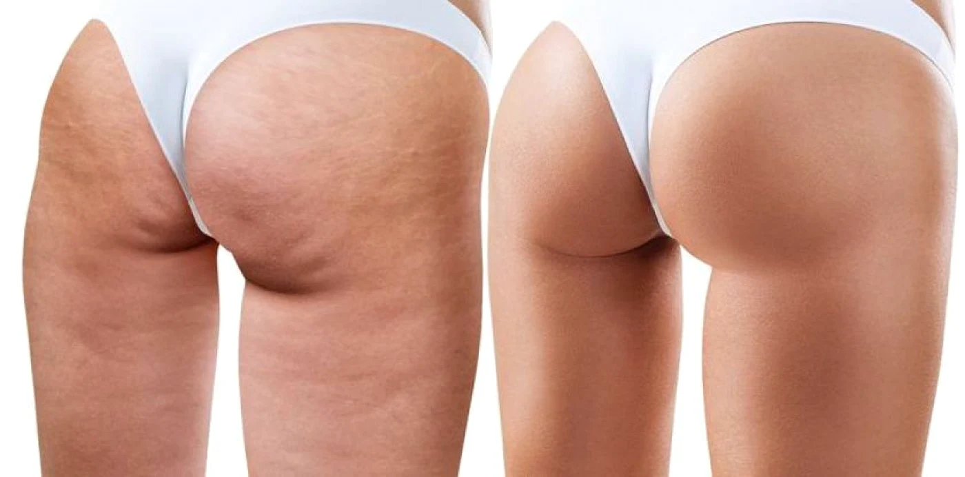 Exerciţii pentru celulită. Top 10 mişcări care elimină aspectul de coajă de portocală