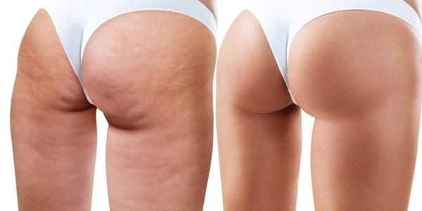 Exerciţii pentru celulită. Top 10 mişcări care elimină aspectul de coajă de portocală
