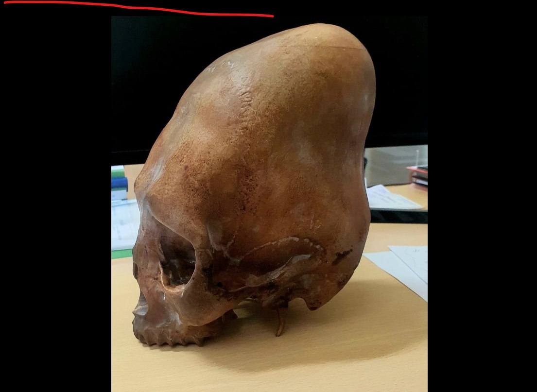 “O tânără cu cap alungit, dovada deformării craniilor la Buzău”