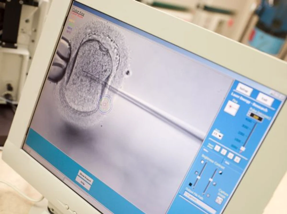 Procedurile de fertilizare in vitro, suspectate de favorizarea cancerului ovarian  FOTO Arhivă