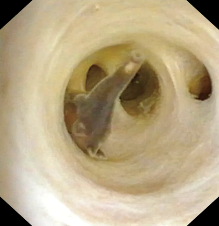 Clonorchis sinensis Liver Flukes jpg