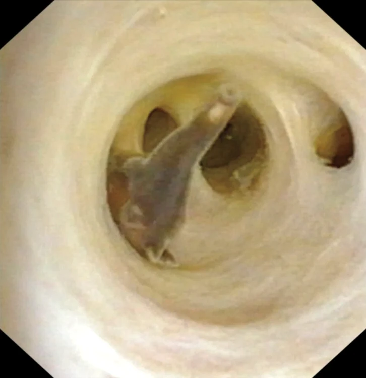 Clonorchis sinensis Liver Flukes jpg