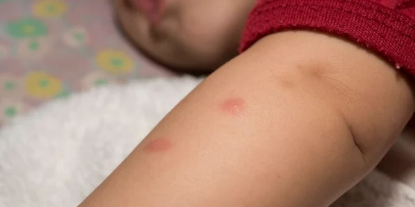 Muşcătură de muscă sau de furnică? Iată cum îţi poţi da seama