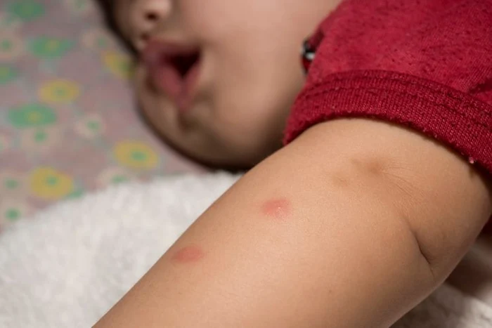 Muşcătură de muscă sau de furnică? Iată cum îţi poţi da seama