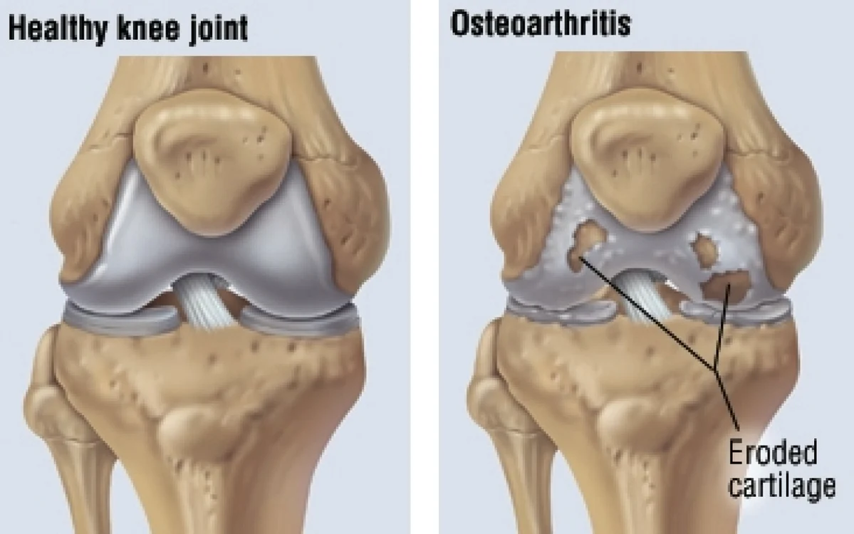 osteortrita