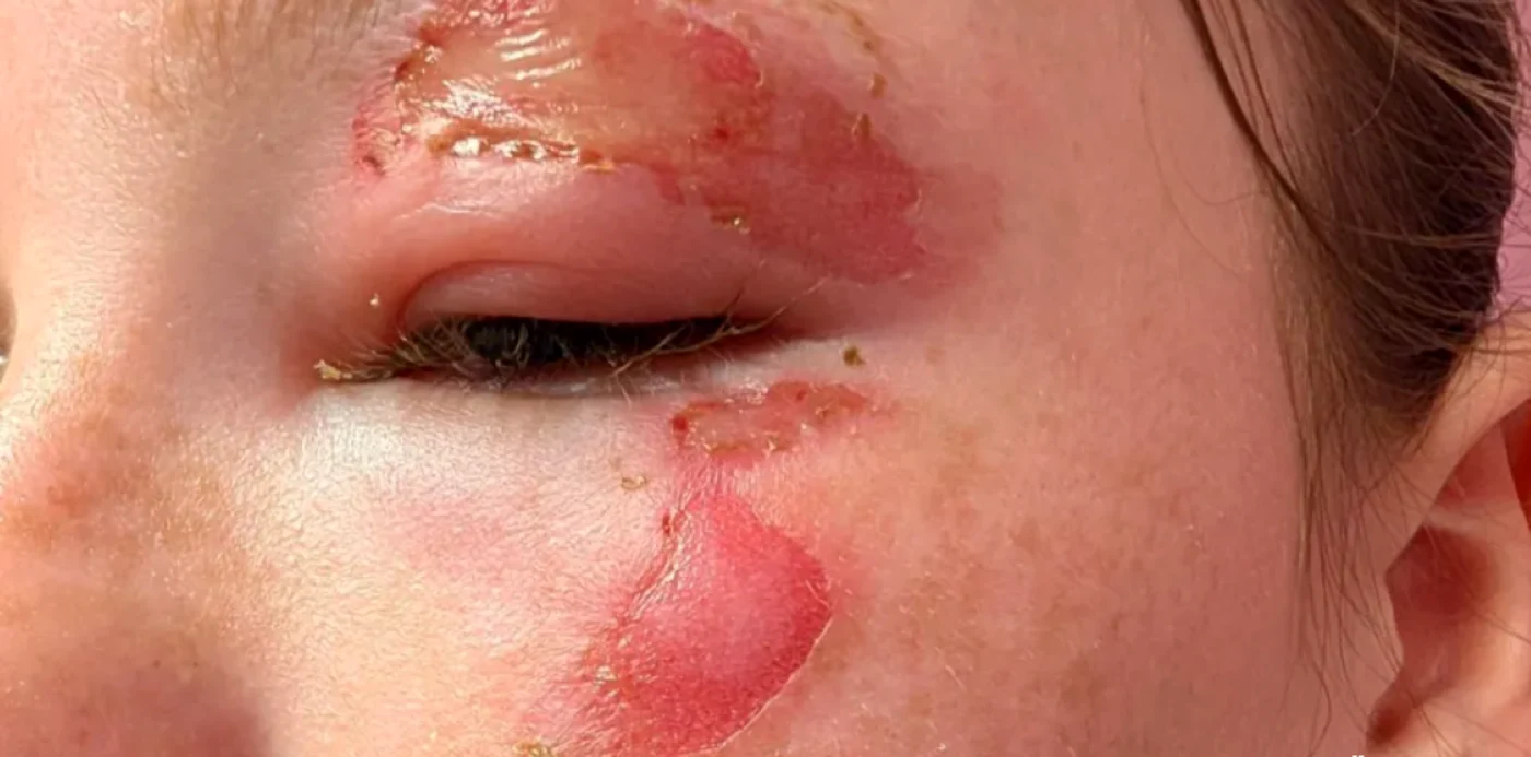 Arsuri provocate de gelul fierbinte din jucărie. FOTO: NHS Greater Glasgow and Clyde