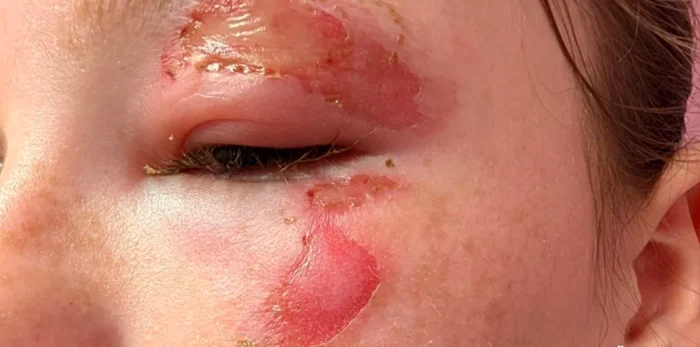 Arsuri provocate de gelul fierbinte din jucărie. FOTO: NHS Greater Glasgow and Clyde