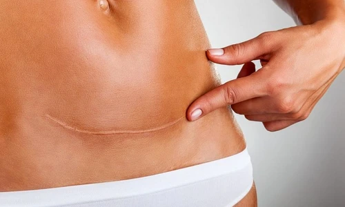 Câte operaţii de cezariană poate face, de fapt, o femeie jpeg