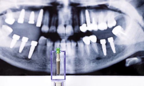 Implanturile dentare Investiție în sănătate orală jpg