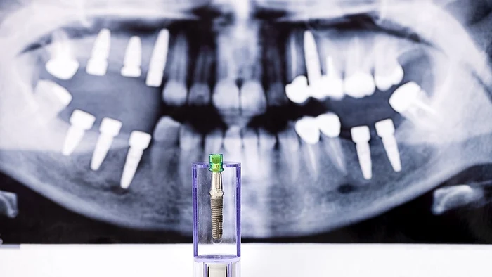 Implanturile dentare Investiție în sănătate orală jpg