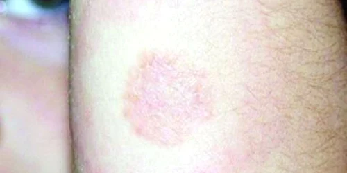 Locul înţepăturii rămâne mai multe zile inflamat şi roşu