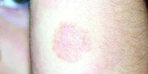 Locul înţepăturii rămâne mai multe zile inflamat şi roşu