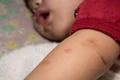 muscatura de musca sau de furnica jpeg