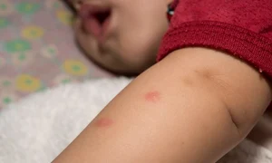 muscatura de musca sau de furnica jpeg