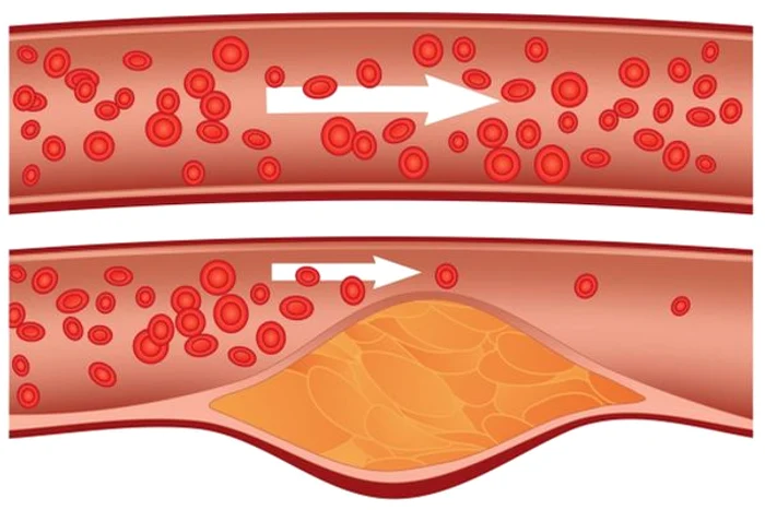 
    Acest remediu natural curăță arterele.www.clickpentrufemei.ro  