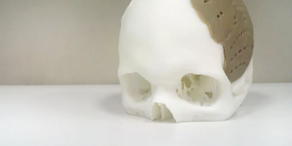 craniu printat 3d