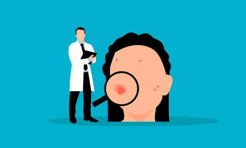 Acneea la maturitate poate fi cauzata de tiroida  Sursa foto Pixabay png