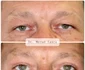blefaroplastie iancu morad luxury 4 jpg