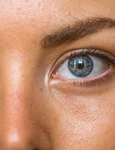 melasma jpg