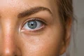 melasma jpg