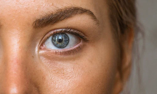 melasma jpg