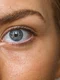 melasma jpg