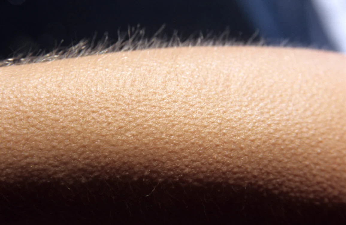 Pielea de găină apare în caz de frig sau emoție